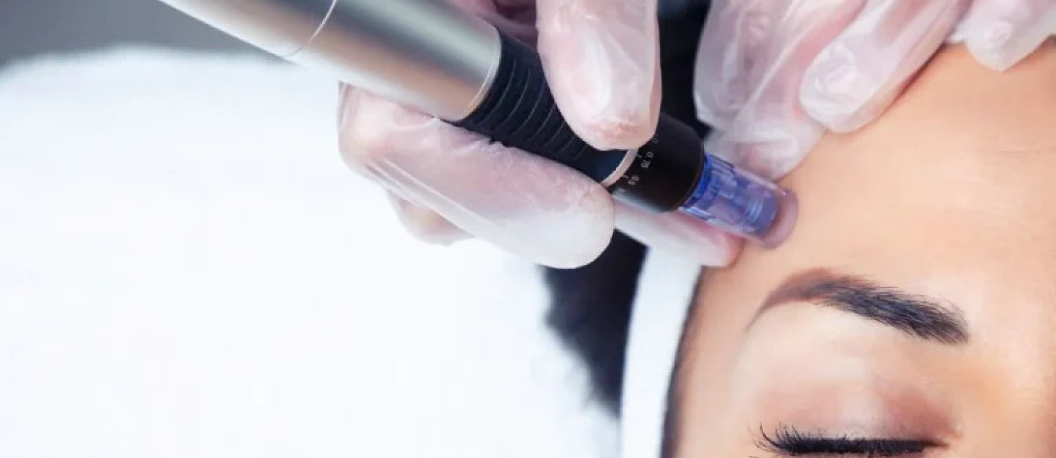 Microagulhamento: benefícios, recuperação e resultados naturais
